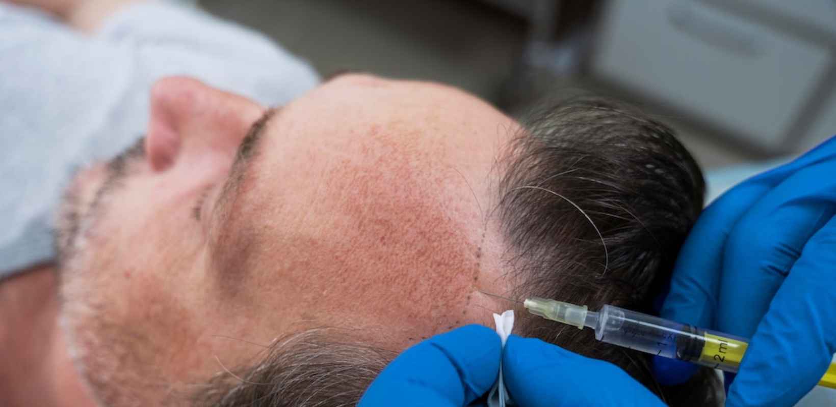 Revitalize Your Hair with  PRP Hair Transplant